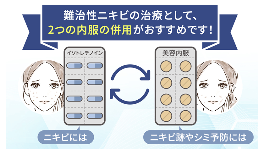 難治性ニキビの治療として2つの内服の併用がおすすめです！